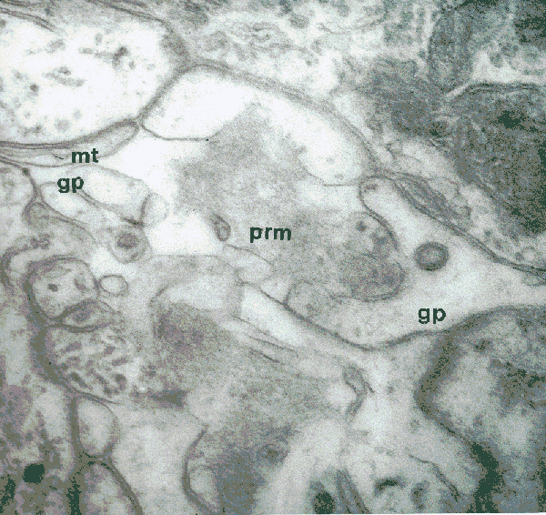 pre-retinal membrane and glial processes